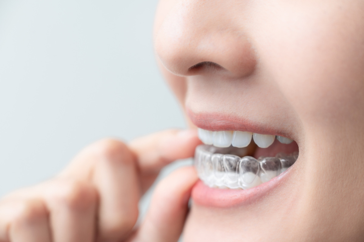 can Invisalign close gaps between teeth