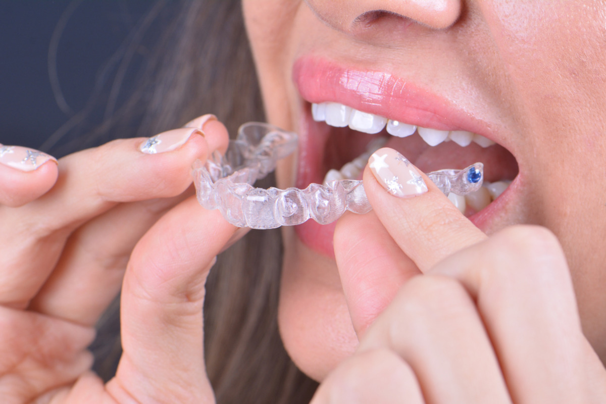 what to do after losing invisalign